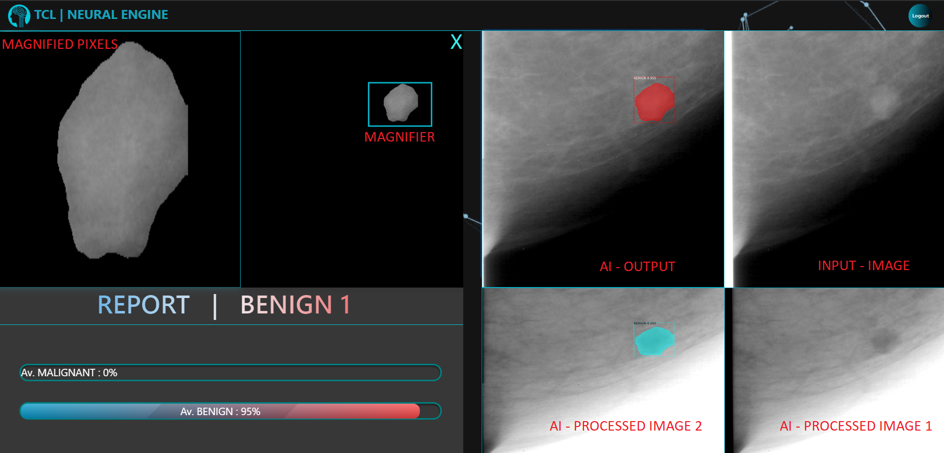 AI - Breast Cancer Classification