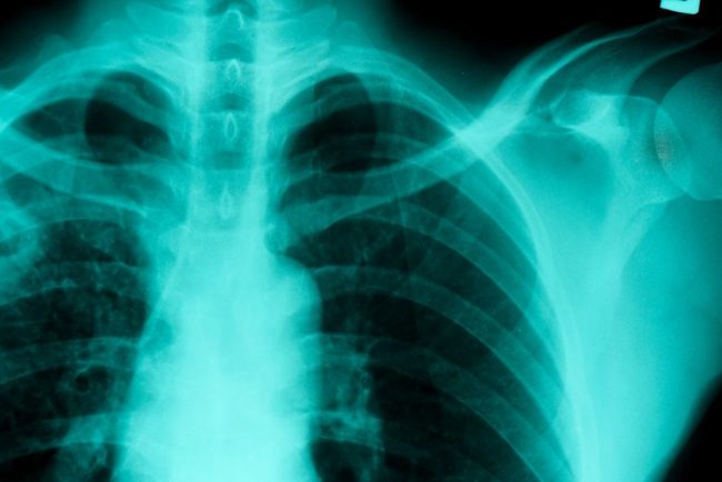 TB detection using AI