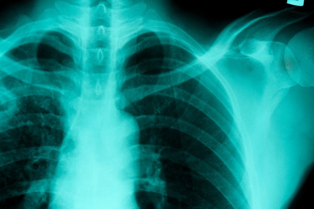 TB detection using AI