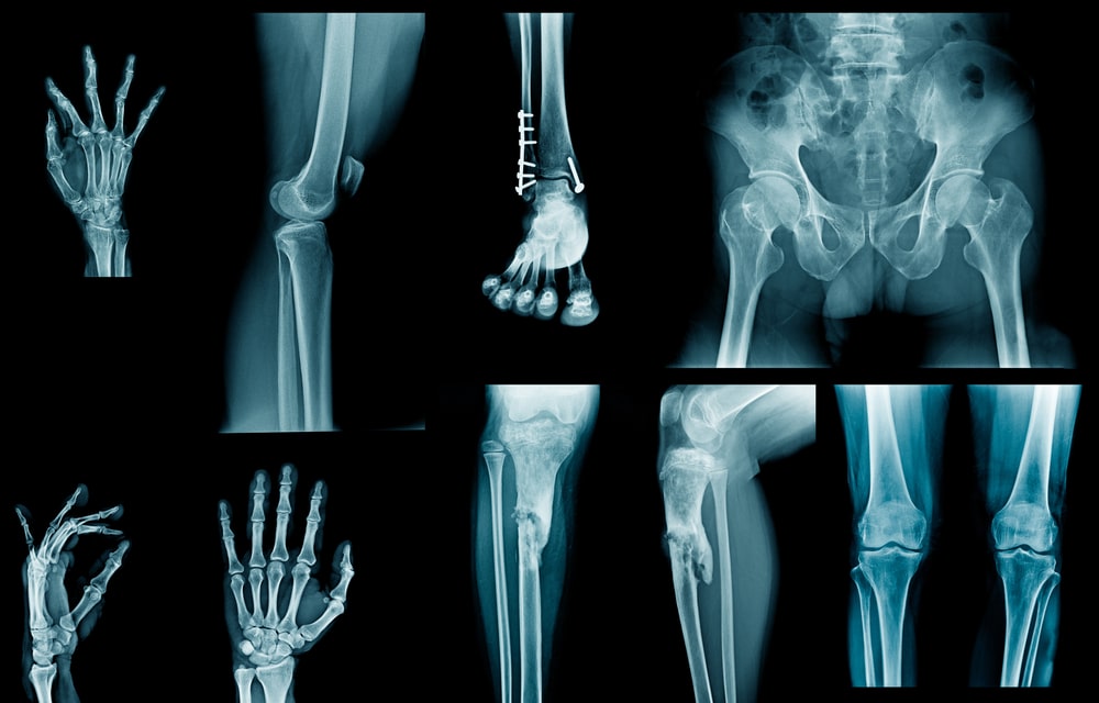 idoc - Limb Fracture Detection