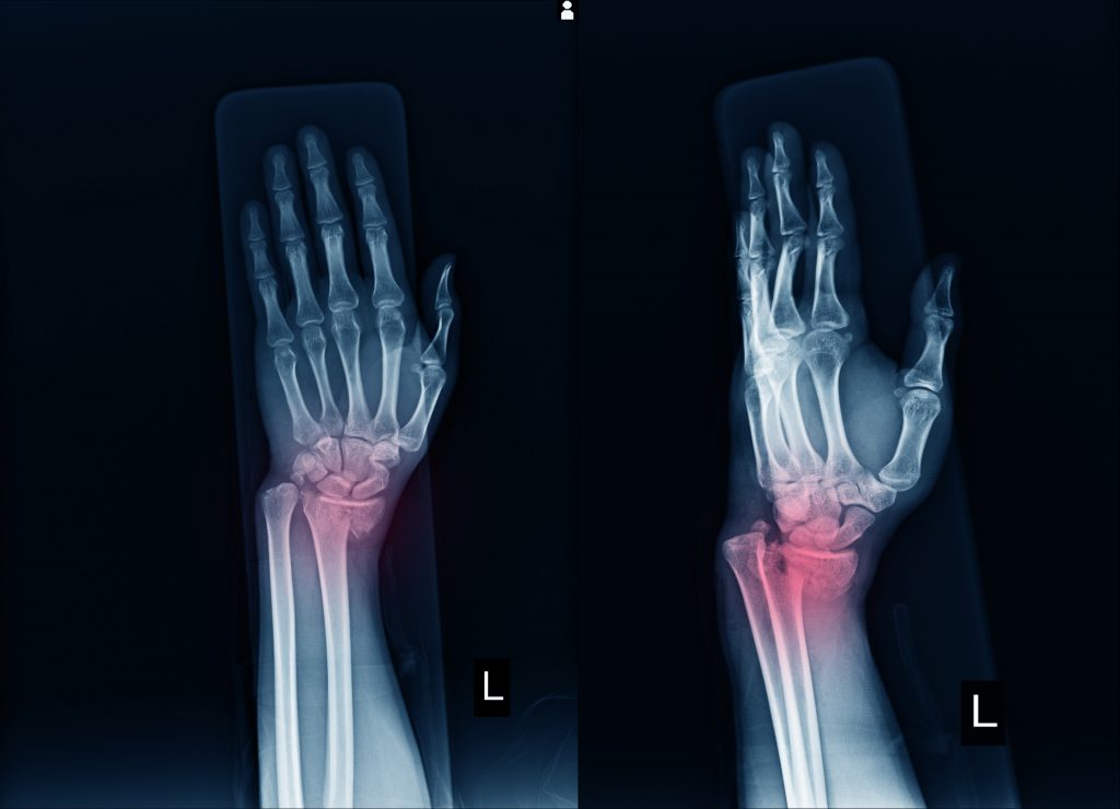 AI in fracture detection- A technical perspective to solve the problem ...